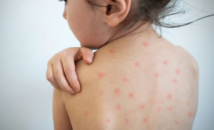 Uganda: al menos 11 niños murieron por un brote de sarampión en&nbsp;Napak